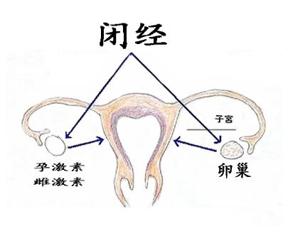 闭经的治疗