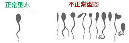 畸形精子症