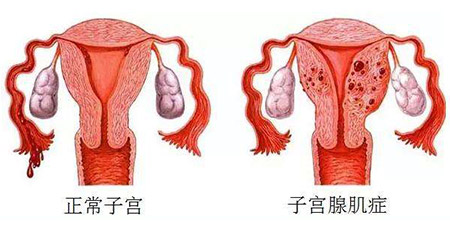 子宫腺肌症