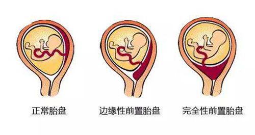 胎盘前置