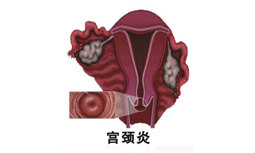 重度宫颈炎用什么药效果好