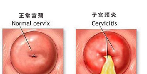 宫颈炎一度怎么治疗