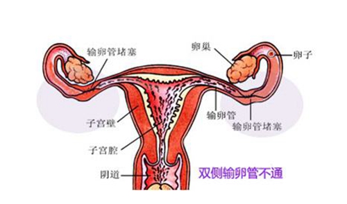 双侧输卵管堵塞治疗费用