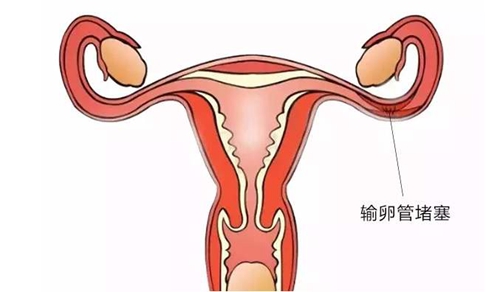 输卵管堵塞会痛吗