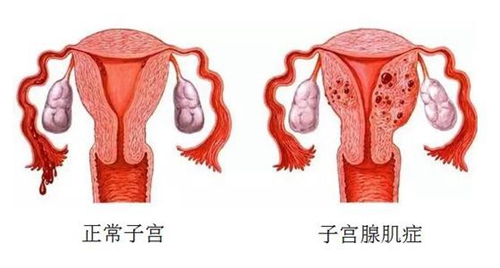 子宫腺肌症