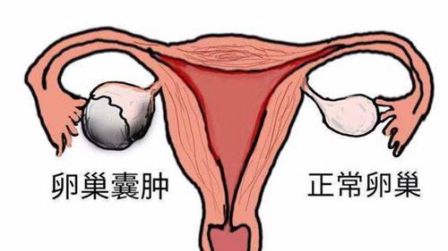 卵巢囊肿影响取卵吗