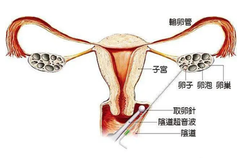 取卵手术